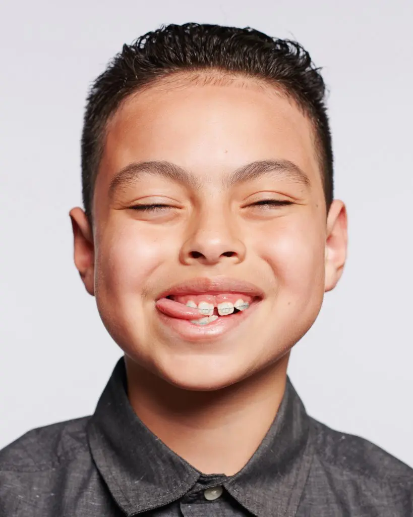 What To Expect From Your First Week In Braces