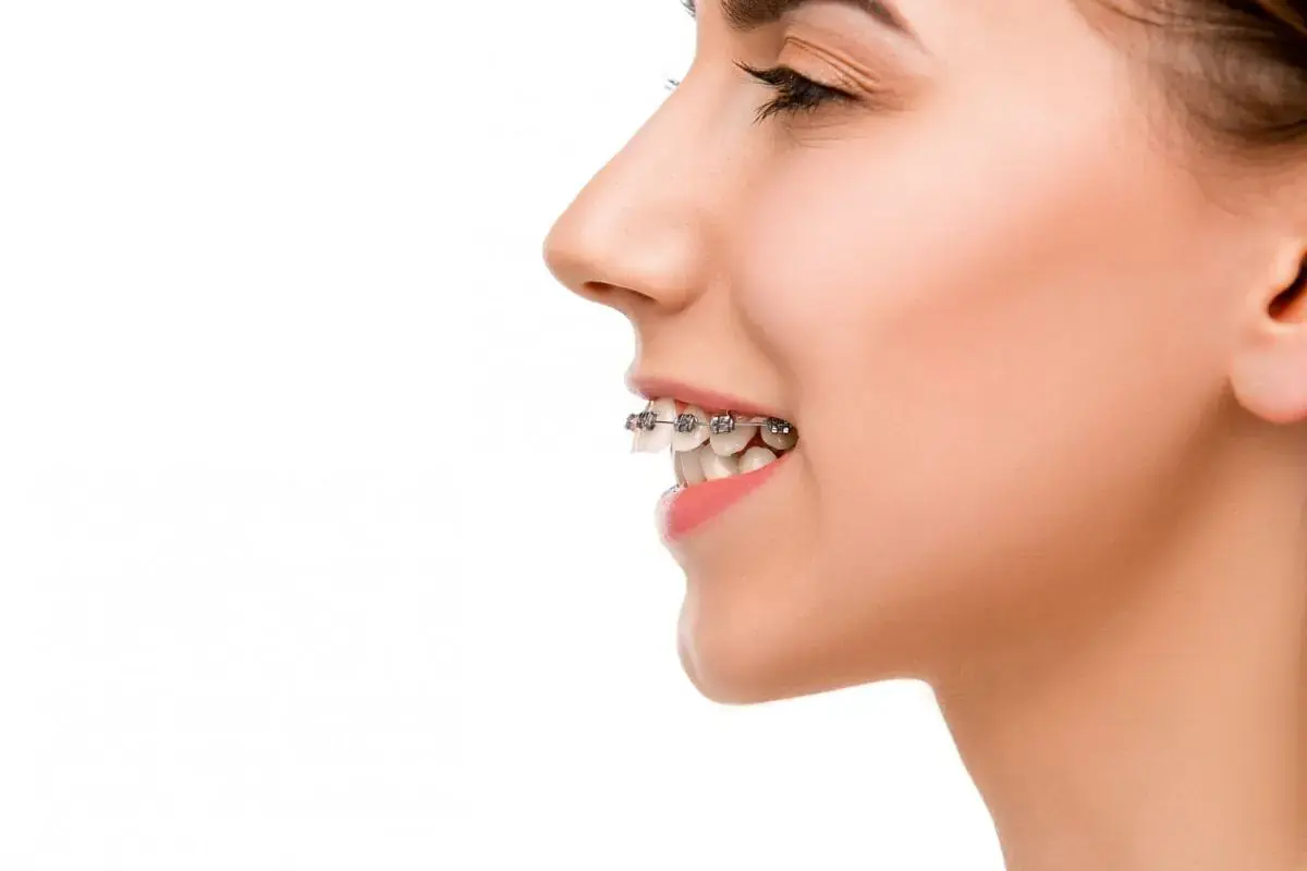 Overbite person smiling in profile view with metal braces from orthodontist in Sammamish and Kent, WA on their teeth against a white background. Overbite person smiling in profile view with metal braces from orthodontist in Sammamish and Kent, WA on their teeth against a white background.