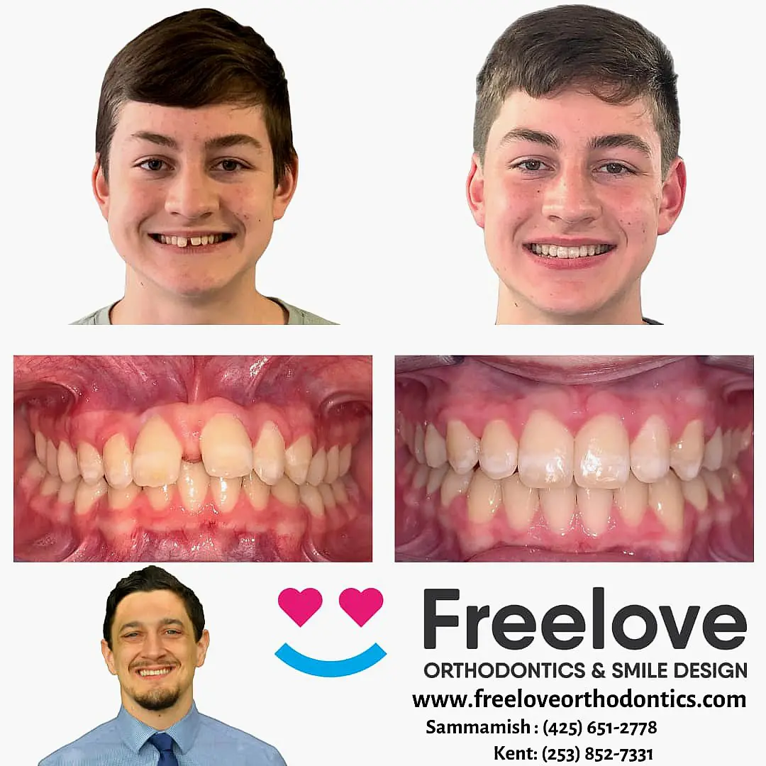 Split image showcasing a young person before and after braces, emphasizing dramatic teeth alignment improvements. Features contact details for Freelove Orthodontics & Smile Design in Sammamish