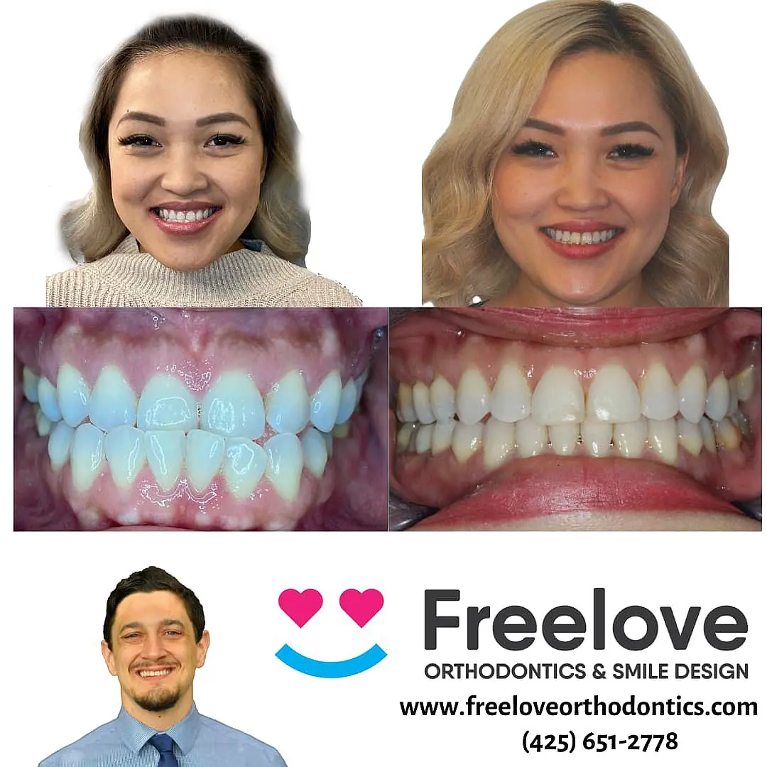 Before and after Invisalign photos of a smiling woman. Includes two close-up images of teeth and an image of a man underneath the company's logo and contact information in Kent
