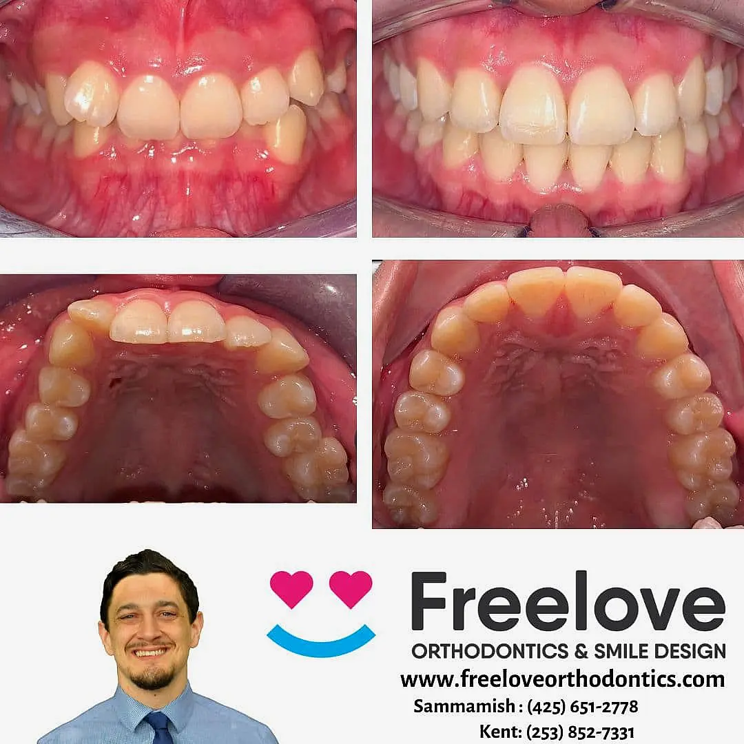 Orthodontic before and after Invisalign photos showcase stunning teeth adjustments. Includes contact information for Freelove Orthodontics & Smile Design, along with a headshot of a smiling person in Kent