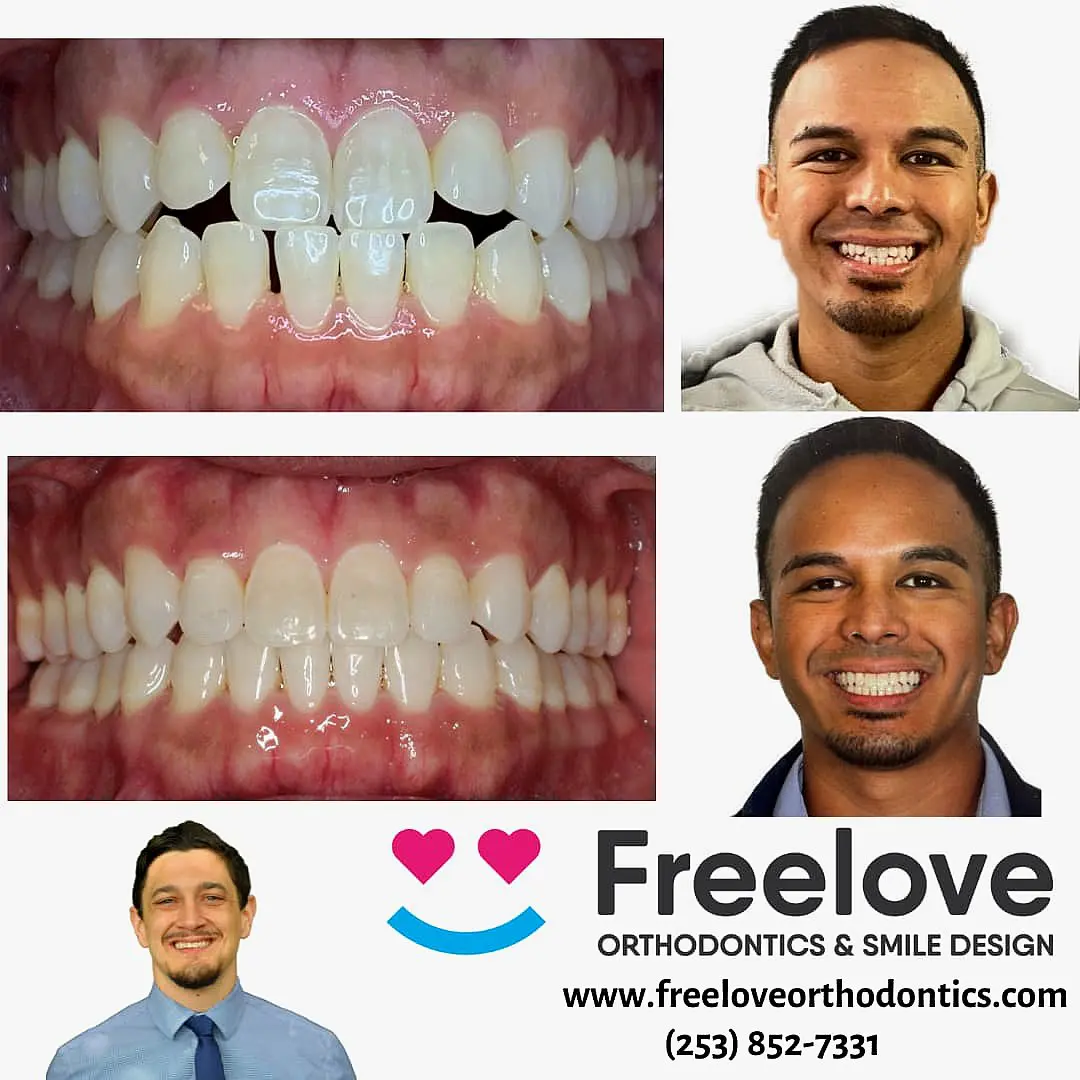 Before and after Invisalign comparison of dental work. The top images show teeth before, and the bottom images reveal improved alignment. Male patient smiles in both sets. Freeylove Orthodontics logo is present in Sammamish