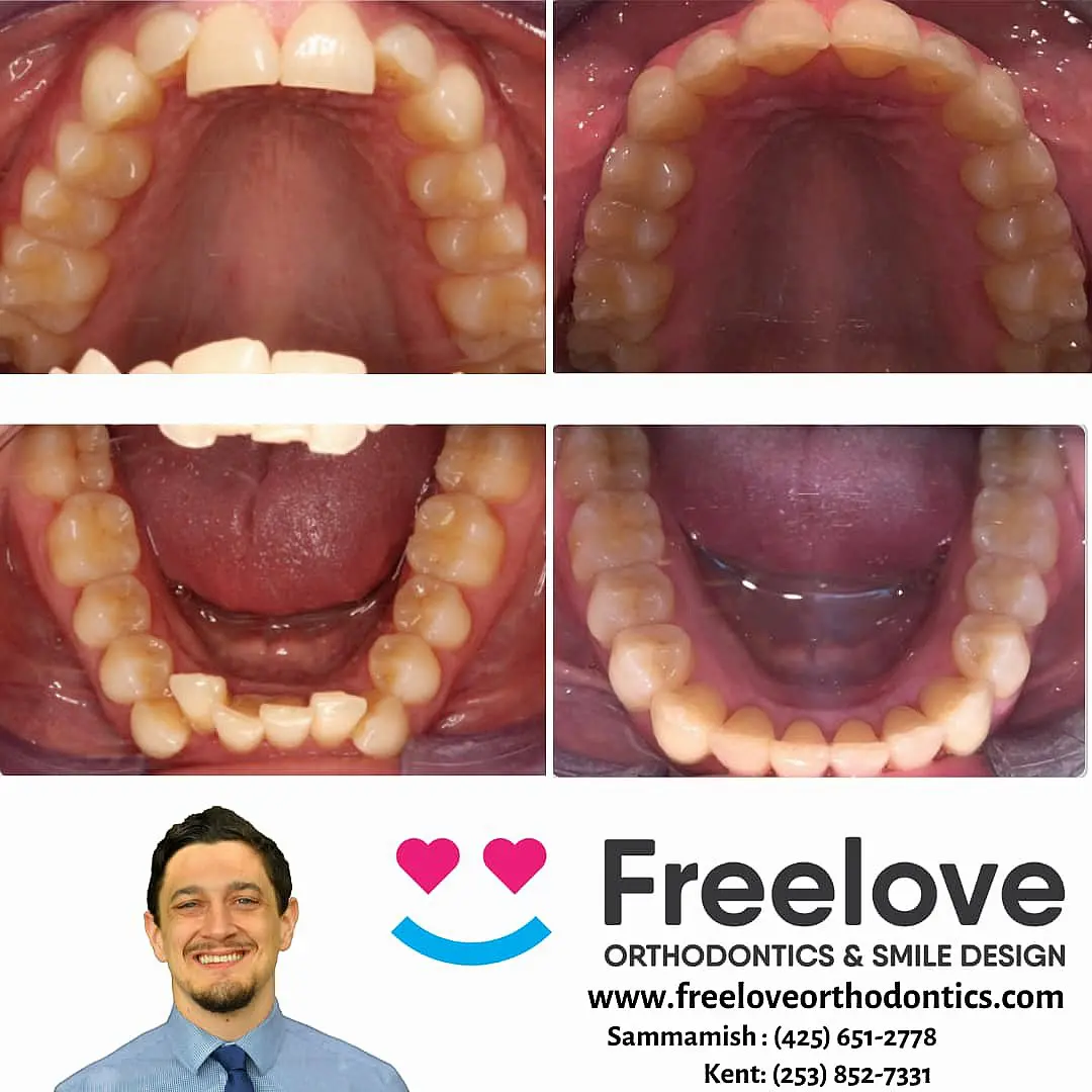 Before and after Invisalign images showcase remarkable teeth alignment improvements. Contact Freelove Orthodontics & Smile Design for more information in Sammamish