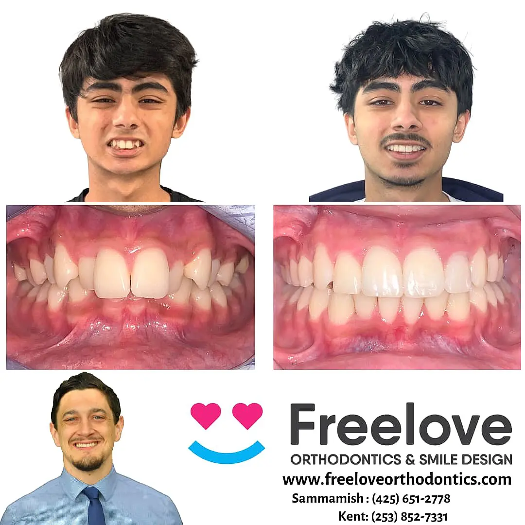 Side-by-side comparison of a young man's teeth before and after braces. Freestyle Orthodontics logo and contact information are below in Kent