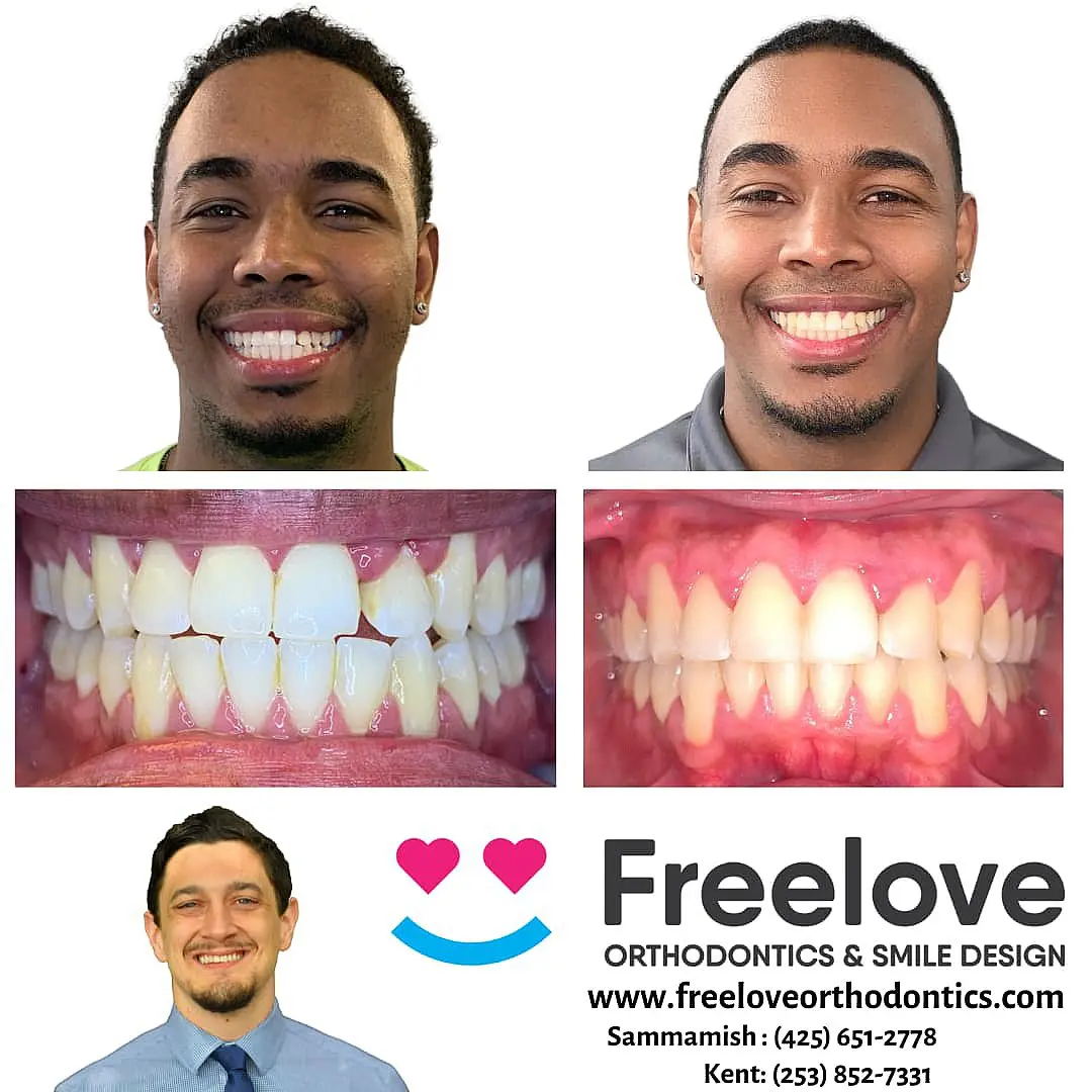 Two smiling men showcase their transformations, with close-ups revealing the remarkable "before and after braces" changes. The Freelove Orthodontics & Smile Design logo and contact information complete the picture of expert care and stunning results in Kent