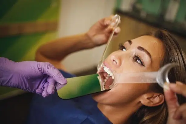 Patient receiving lingual braces in Sammamish, WA, with mouth held open by a dental tool during the procedure, attended by a person wearing purple gloves.