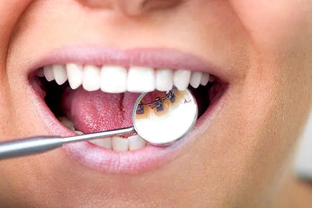 Close-up of an open mouth showing teeth. A dental mirror reflects braces on the inside of the lower teeth in Sammamish, WA.