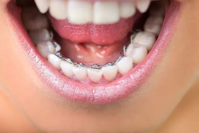 Close-up of a person's open mouth showcasing lingual braces on the lower teeth, expertly aligned in Kent, WA.