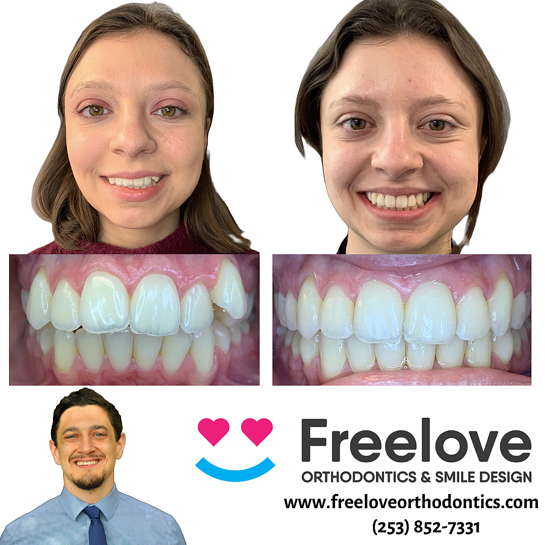 Before After pictures of braces patient in Sammamish