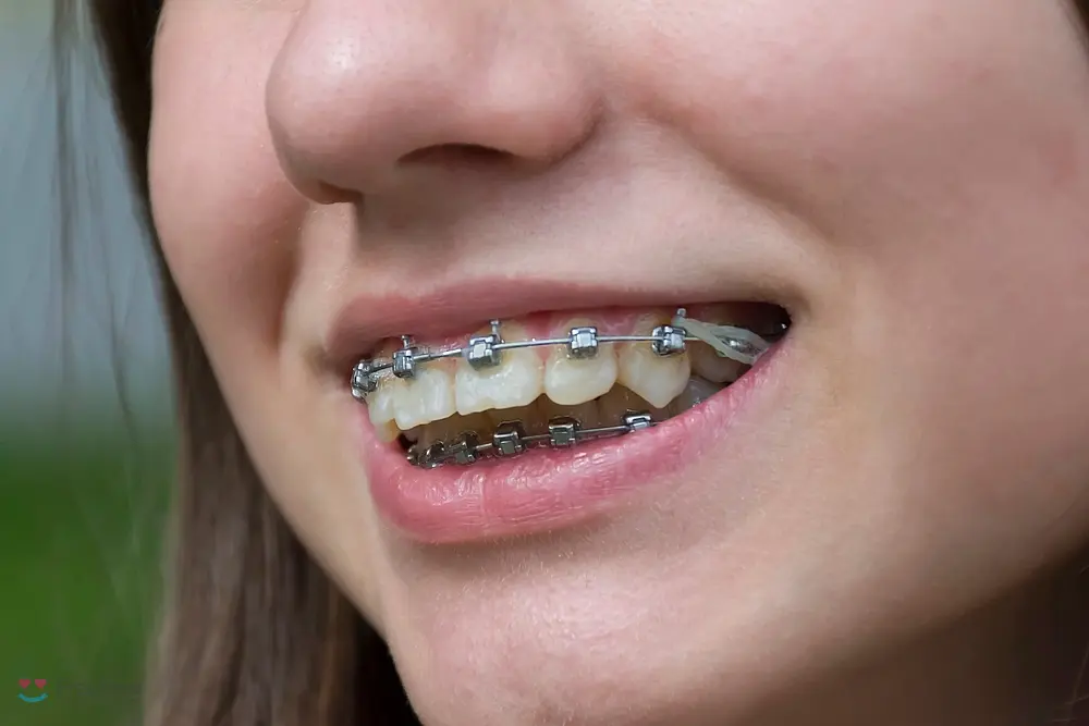 Close-up of a person's mouth showing metal braces with elastics, ideal for those seeking braces for overbite in Kent and Sammamish, WA.
