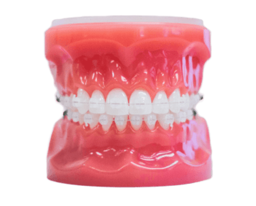 clear ceramic braces on plastic model