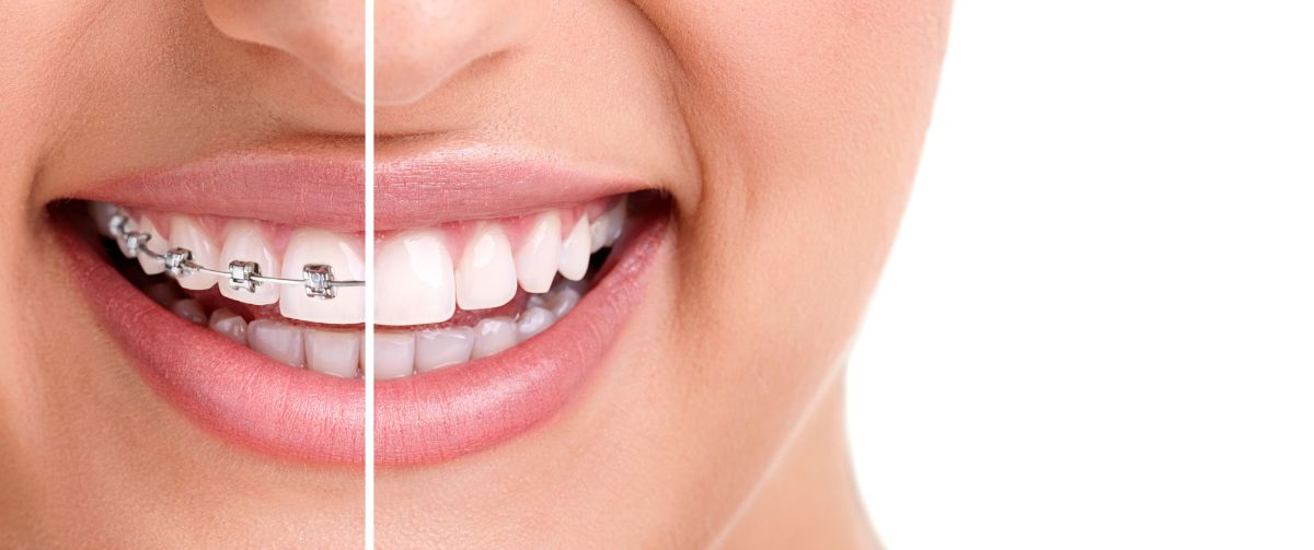 Best Orthodontic Treatment Option for Adults