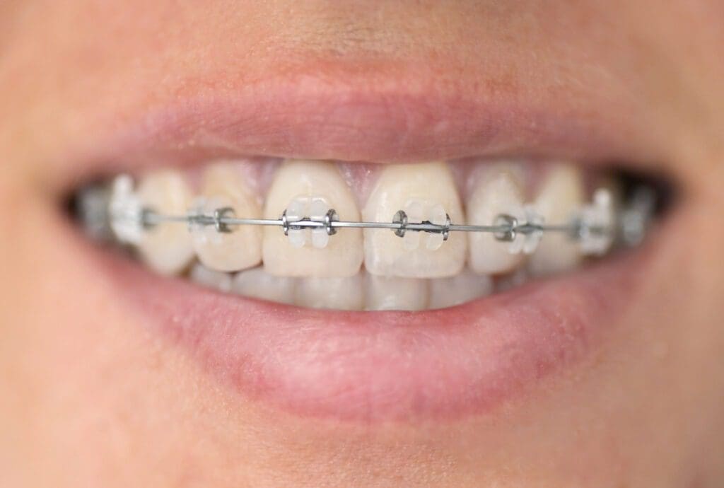 What is cosmetic orthodontics?